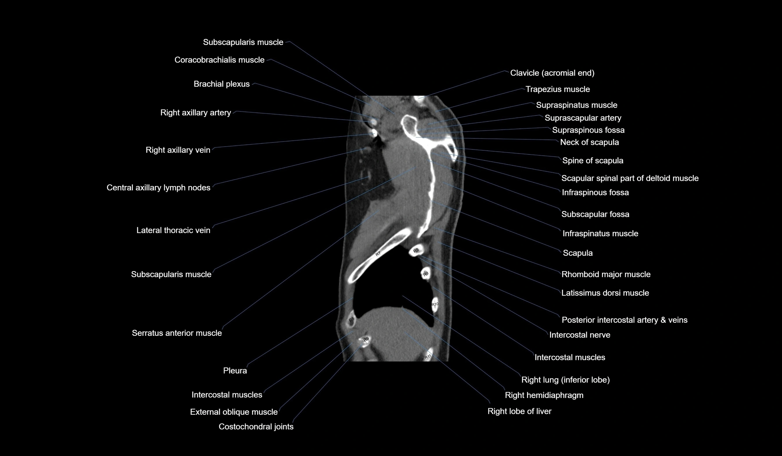 CT chest (thorax) labelled sagittal cross sectional anatomy radiology image-00017.webp